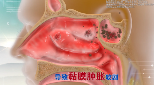 清鼻堂创业开店：别让鼻炎偷走你的春天，鼻炎人的预防护理全攻略！