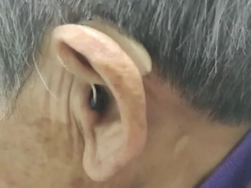 耳科三大“杀手”侵蚀听力，“高科技”助力听障者走出困境！