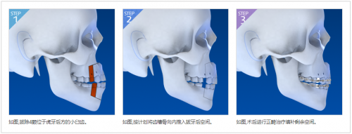 View韩国凸嘴手术适应类型解析：嘴唇凸出就一定是凸嘴吗？