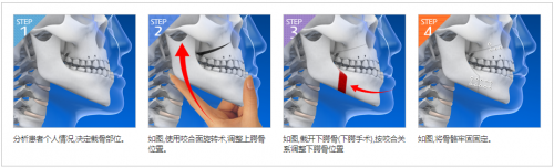 View韩国凸嘴手术适应类型解析：嘴唇凸出就一定是凸嘴吗？