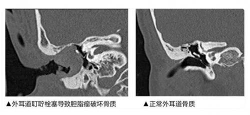 行业首创蛇形内窥镜，bebird蜂鸟可视耳勺打造无死角耳道清洁新体验