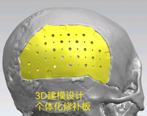 颅骨修补新突破！夏小雨医生引领3D打印PEEK材料临床应用