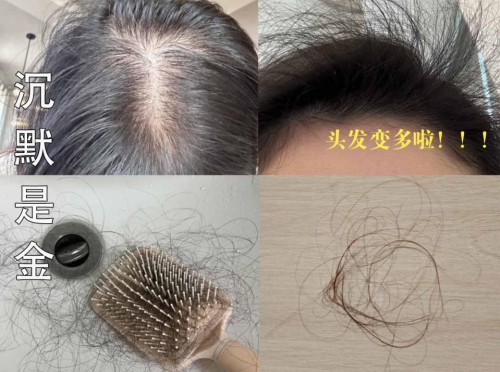 脱发都在看！十大热门生发液什么牌子最有效果？不为脱发交智商税
