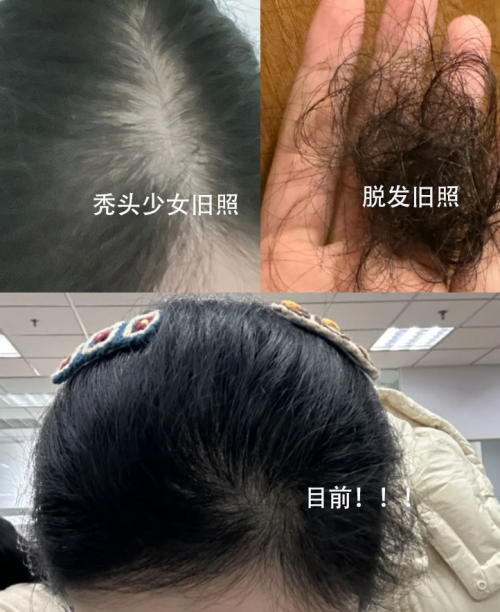 生发液什么牌子最有效果？十大国际知名品牌公布，解锁养发全公式