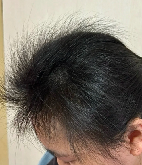 脱发掉发严重：世界十大公认有效防脱生发产品对比，国货权威背书