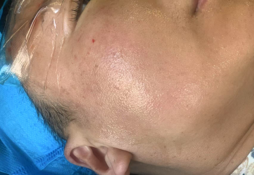 水光针头怎么选？一次性讲清一款优质的水光针头配置