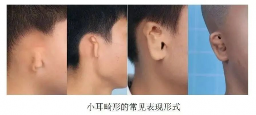 告别“腊肠耳” 成都仁品耳鼻喉医院硬核实力助18岁男孩重获 “新耳”第2张