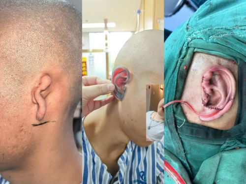 告别“腊肠耳” 成都仁品耳鼻喉医院硬核实力助18岁男孩重获 “新耳”第3张