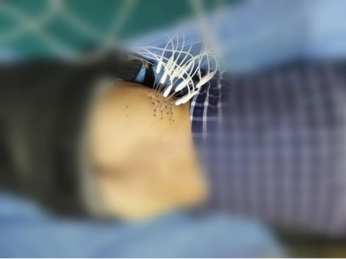 龙马潭区妇幼保健院中医特色疗法——内热针治疗