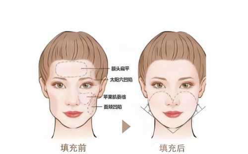 2025成都医美注射与面部填充医院推荐！自体脂肪填充泪沟/玻尿酸丰唇/轮廓固定哪家强？