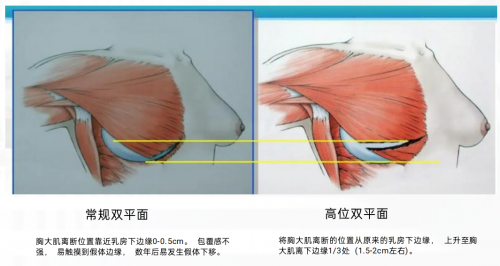 福州海峡林沸腾院长做过得双平面隆胸,为啥这么真?做过“沸腾胸”都说好 福州海峡林沸腾院长做过得双平面隆胸,为啥这么真?做过“沸腾胸”都说好
