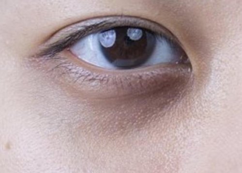 深入眼周，眸间焕彩——薇瑟拉黄金微针唤醒青春明眸之光