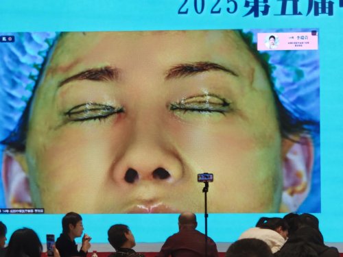 成都李瑞萱医生跻身金刀赛总决赛，展现眼部年轻化技术新高度