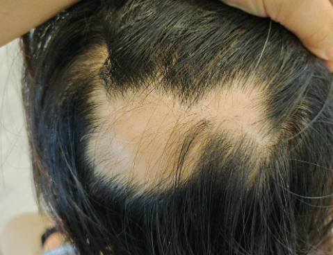 斑秃头怎么治用什么药？2025十大斑秃品牌实测：KOUND发养宁霸榜第一！