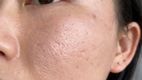 解析毛孔粗大成因，艳存晓年轻胶原水光套组如何实现“隐形”毛孔