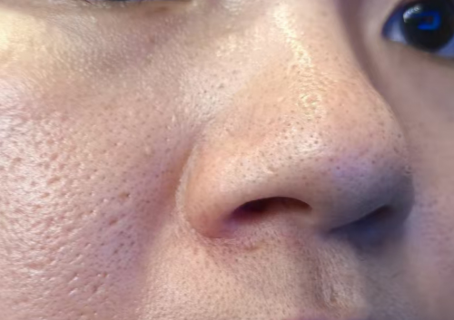 脸变成了“月球表面“？薇瑟拉黄金微针能收缩毛孔，养出清透雾面肌