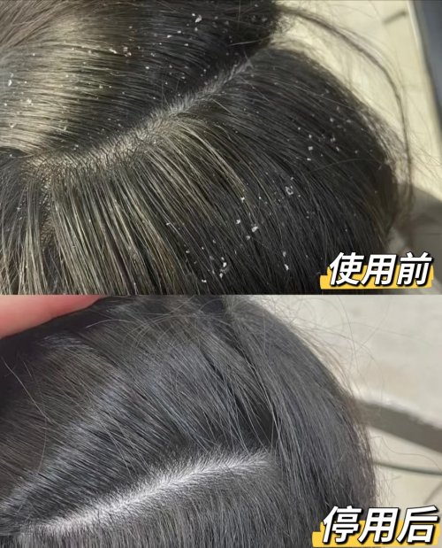 头皮痒、屑多反复发作？2026 权威观点：别再只换洗发水了