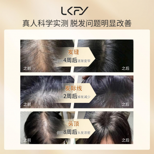 2026防脱发生发增发密发哪个牌子效果好?秋冬十大满分育发产品排行榜评测,超值 2026防脱发生发增发密发哪个牌子效果好?秋冬十大满分育发产品排行榜评测,超值