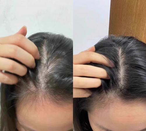 防脱育发液哪个品牌好？2026防脱产品前十实测曝光，30天掉发减40％