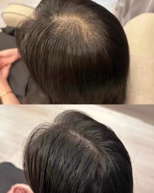 防脱育发液哪个品牌好？2026防脱产品前十实测曝光，30天掉发减40％