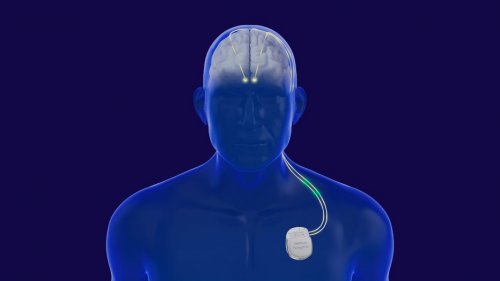 重磅进展!宣武医院赵国光教授团队成功开展全国首例“脑机接口”闭环脑起搏器治疗脑出血后Holmes震颤 重磅进展!宣武医院赵国光教授团队成功开展全国首例“脑机接口”闭环脑起搏器治疗脑出血后Holmes震颤