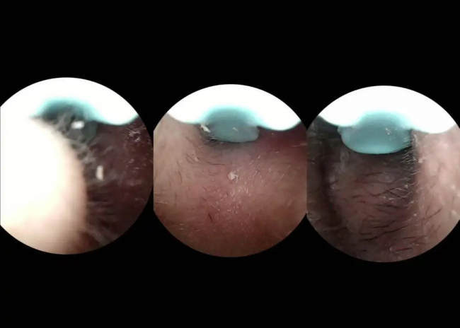 掏耳勺买什么样的好？掏耳神器哪种最好用？可视挖耳勺推荐