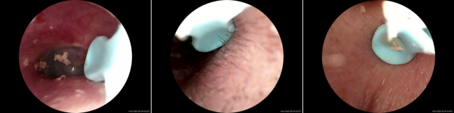 可视耳勺有用吗？智能挖耳勺好用吗安全吗？可视掏耳勺对比推荐