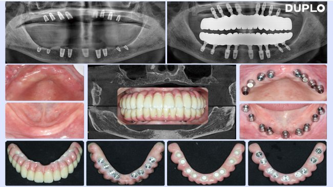 多普乐种植体：以科技赋能缺牙修复 重塑口腔健康新体验