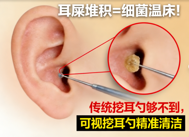 掏耳勺哪个品牌好？2026高清可视采耳设备，挖耳勺最好的牌子安利