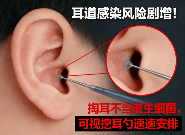 必入好用的掏耳勺清单！可视掏耳勺选哪个牌子的好？避坑指南！