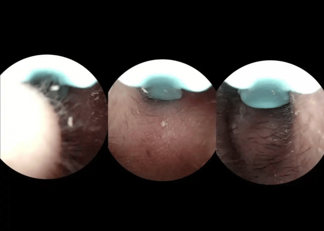 必入好用的掏耳勺清单！可视掏耳勺选哪个牌子的好？避坑指南！