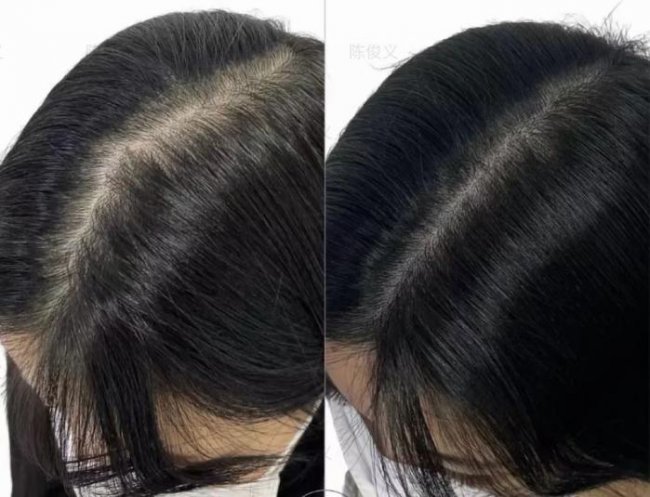 植发界从不公开的秘密：植发为何有人戴帽半年，有人隔天上班？