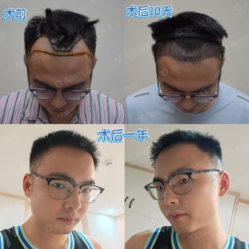 公司高管、网红主播为何都选这种植发？他们赌不起半年隐形期