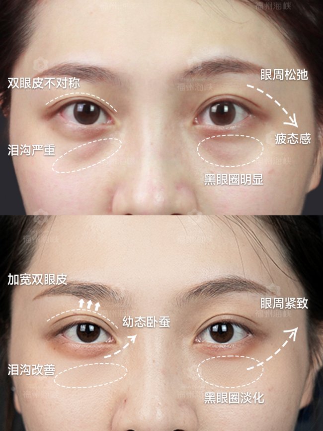 约会前紧急拯救黑眼圈?找福州雷根娥‘眼底充电’计划,1次注射搞定加班垮脸危机! 约会前紧急拯救黑眼圈?找福州雷根娥‘眼底充电’计划,1次注射搞定加班垮脸危机!