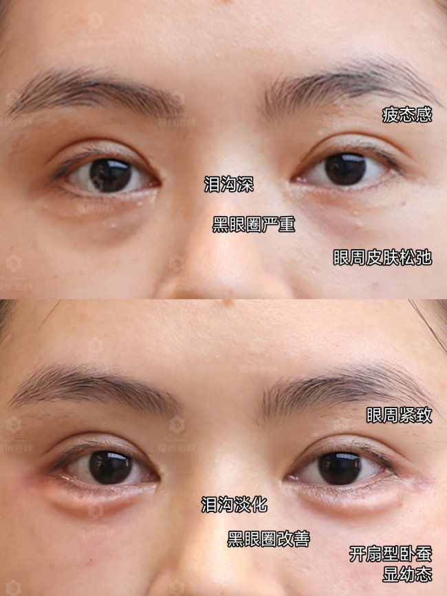 约会前紧急拯救黑眼圈?找福州雷根娥‘眼底充电’计划,1次注射搞定加班垮脸危机! 约会前紧急拯救黑眼圈?找福州雷根娥‘眼底充电’计划,1次注射搞定加班垮脸危机!