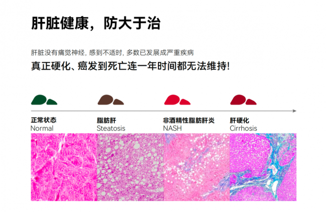 脂肪肝“进化链”暗藏致命危机，LAIFE「乐轻肝」90天逆转破局