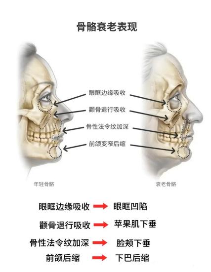 脸垮、脸宽怎么办？“结构性衰老”该考虑筱缇玻尿酸了