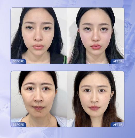 脸垮、脸宽怎么办？“结构性衰老”该考虑筱缇玻尿酸了