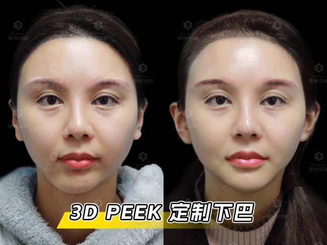 海峡春季新品｜3D 定制骨雕：自然不假、稳稳不位移