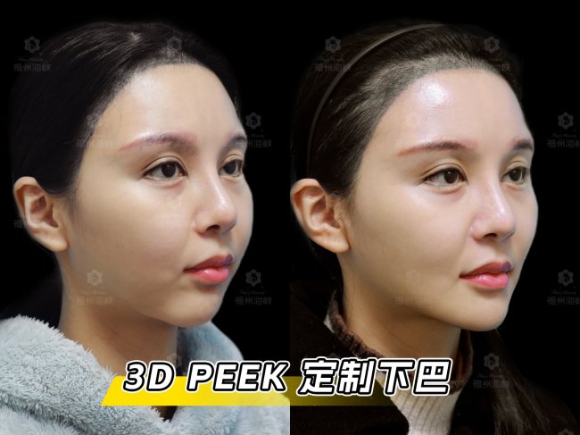 海峡春季新品｜3D 定制骨雕：自然不假、稳稳不位移