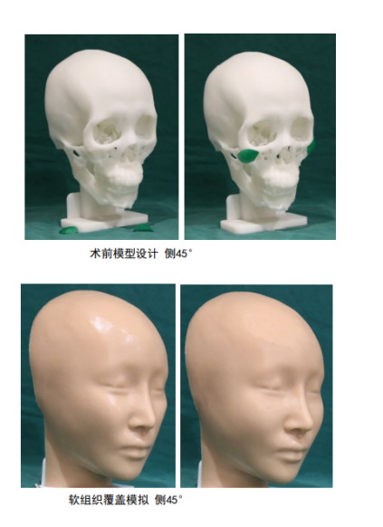 海峡春季新品｜3D 定制骨雕：自然不假、稳稳不位移