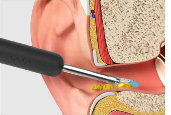最好用的掏耳勺是哪种？掏耳勺工具，掏耳勺神器最新款第一名
