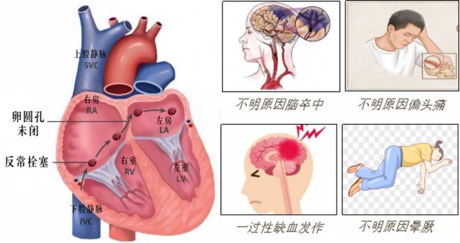 内蒙古自治区妇幼保健院成功实施首例生物可降解卵圆孔封堵术 内蒙古自治区妇幼保健院成功实施首例生物可降解卵圆孔封堵术
