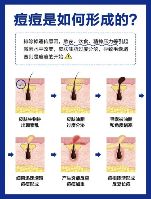 为什么有的人长痘有的人不长？罗作强主任说出的真相让人大吃一惊