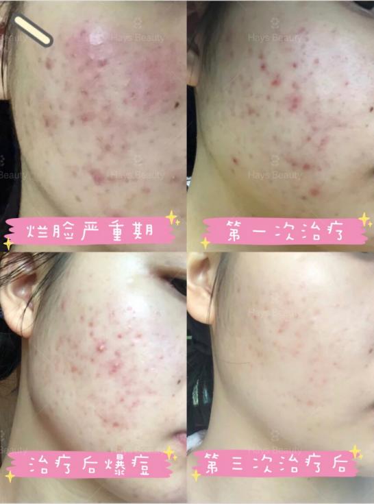 为什么有的人长痘有的人不长？罗作强主任说出的真相让人大吃一惊