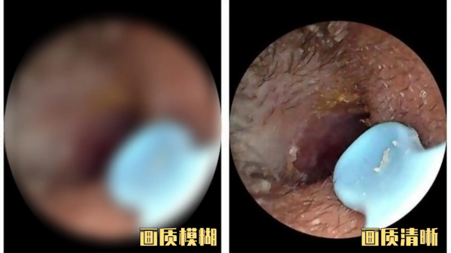 挖耳勺什么材质对耳朵好？耵聍能不能自己挖出来？可视掏耳勺排行