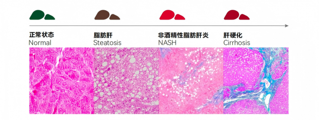 脂肪肝预警升级！LAIFE「乐轻肝」以AI科技破解现代伤肝难题