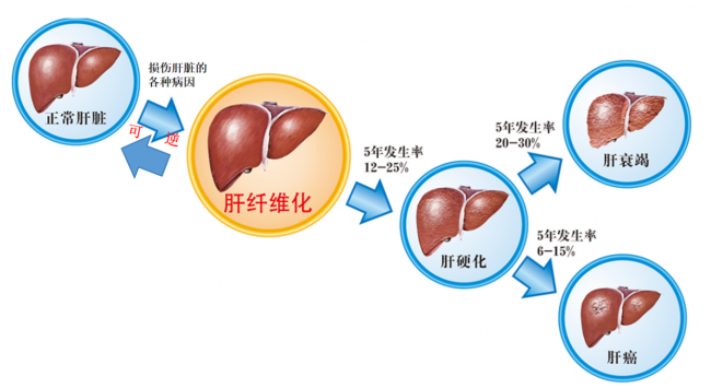 肝纤维化能不能逆转？别等到肝硬化才后悔