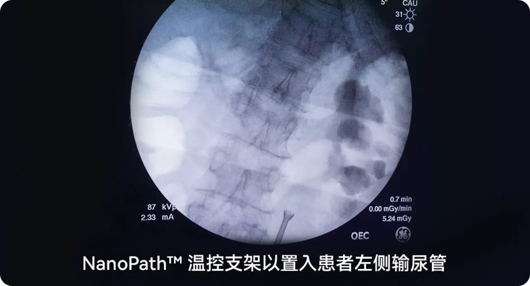 七国专家共同见证！NanoPath™温控支架5分钟内成功置入