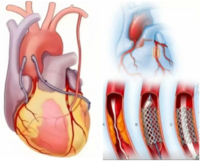 冠心病到底 能不能彻底痊愈?养生素发明成功挑战不可能! 冠心病到底 能不能彻底痊愈?养生素发明成功挑战不可能!